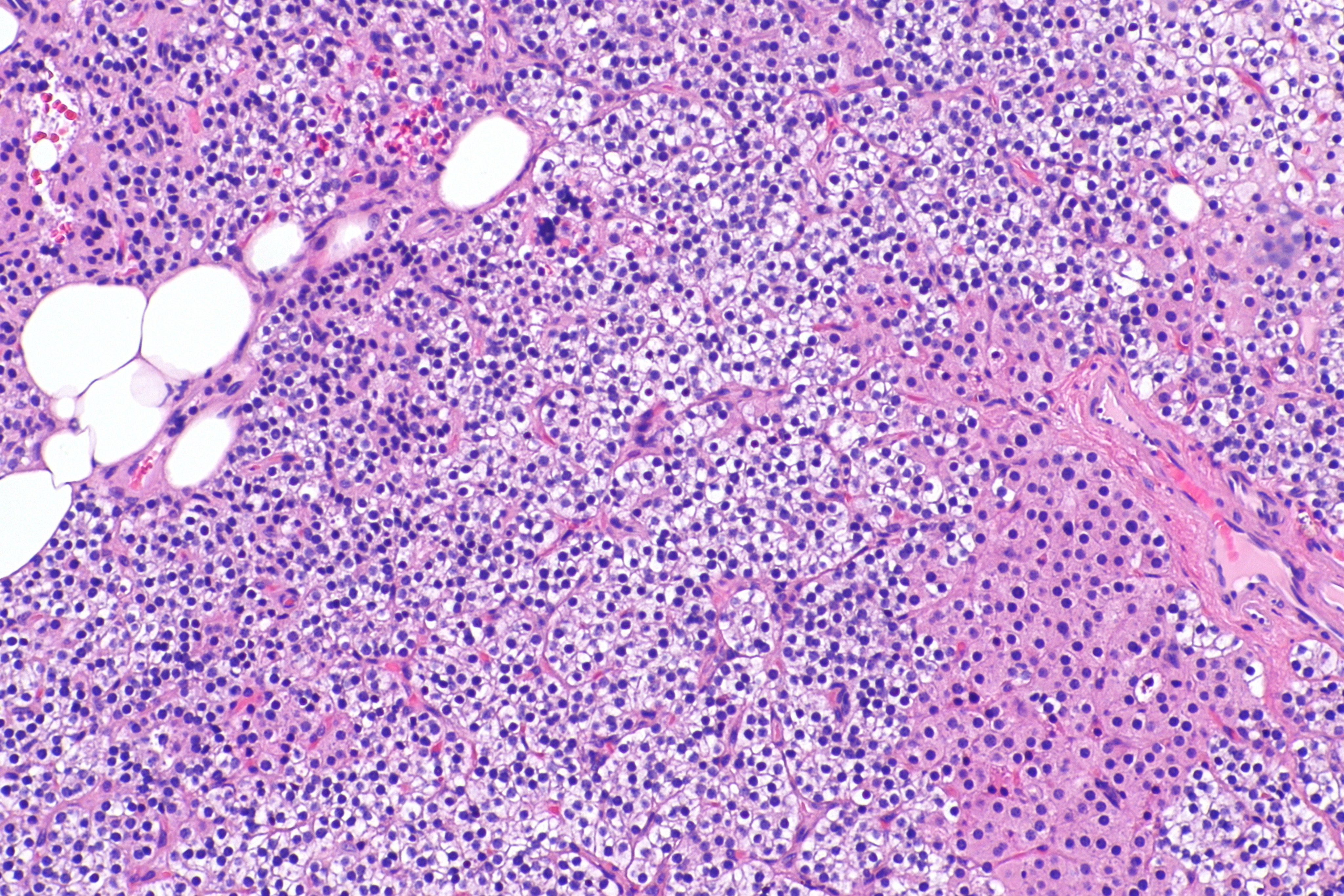 Micrograph showing a parathyroid hyperplasia (H&E stain) on intermediate magnification.Parathyroid adenoma is a clinicopathologic diagnosis. The histology is nonspecific. -Source: Wikimedia commons