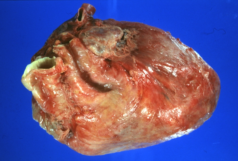 Acute myocardial infarction with epicardial fibrin