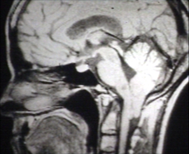 Brain: Arnold Chiari I; T1 (MRI)