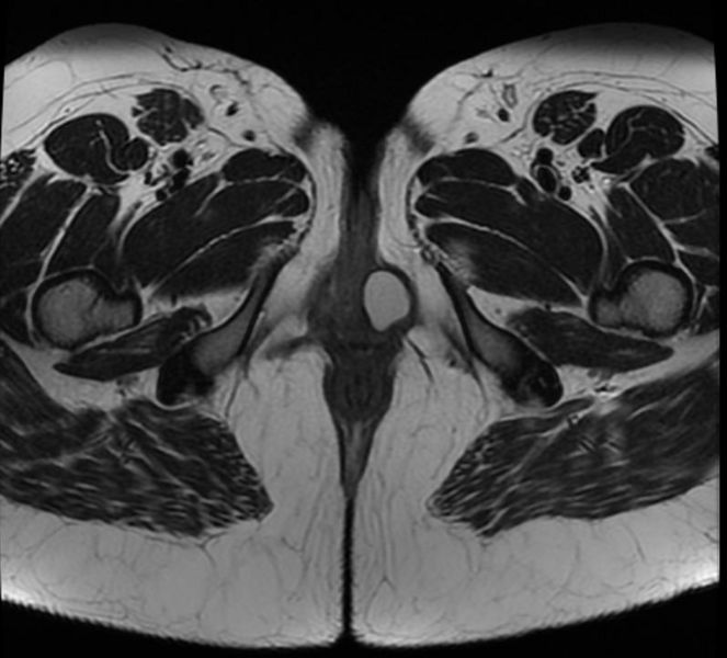 Bartholin's gland cyst 002.jpg