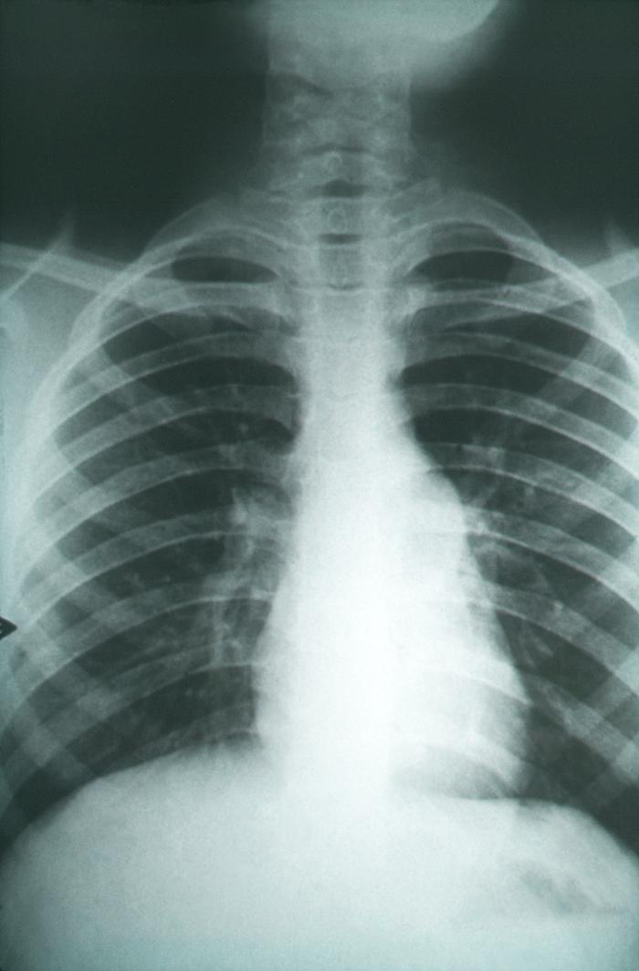 Chest x-ray revealed pulmonary changes indicative of pulmonary fibrosis in a case of coccidioidomycosis. From Public Health Image Library (PHIL). [1]