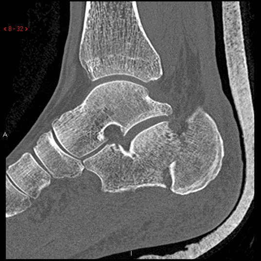 Sagittal bone window Comminuted fracture of the calcaneus.
