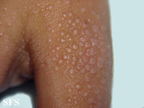 Lichen nitidus. Adapted from Dermatology Atlas.[8]