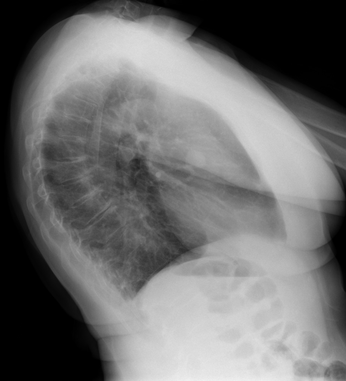 Lateral chest x-ray (CXR) shows a well circumscribed soft tissue attenuation lesion overlapping the heart.