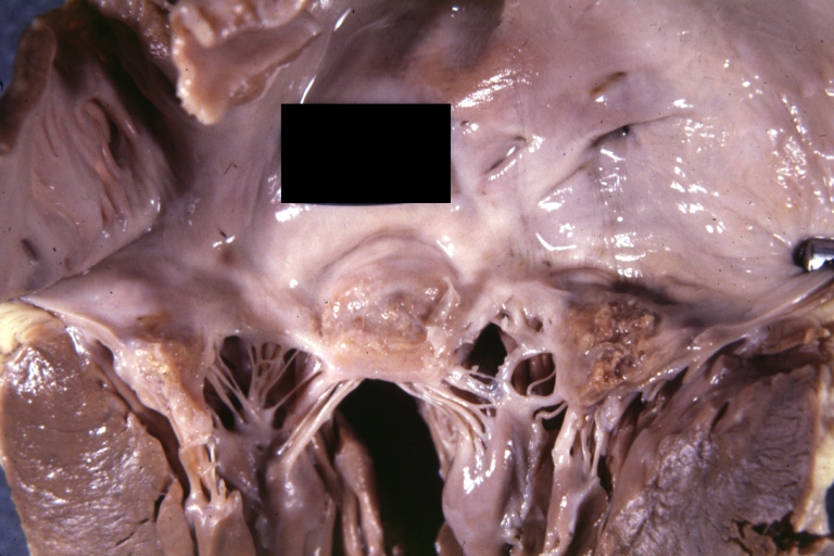 Gross, an excellent example of mitral scarring due to rheumatic fever (healing phase of an infectious lesion).