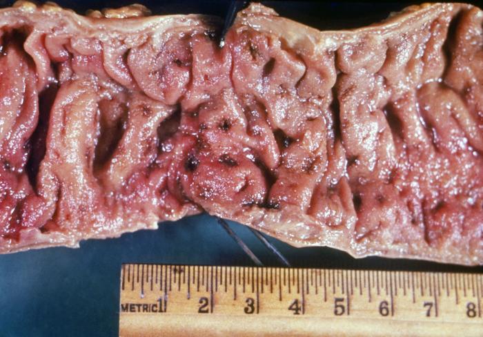 Intestinal ulcers due to amebiasis. Adapted from Public Health Image Library (PHIL). [8]