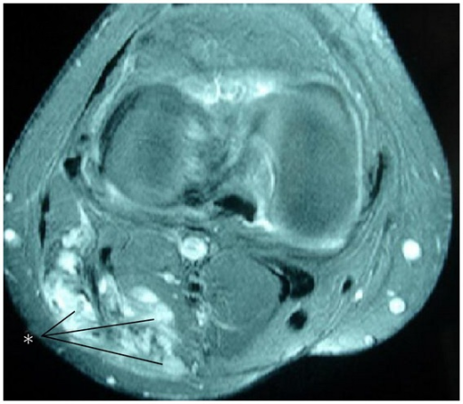 File:Desmoid popliteal MRI.png