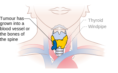 File:Diagram showing stage T4b thyroid cancer CRUK 273.png