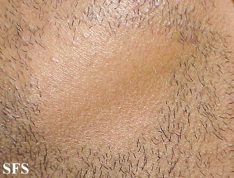 File:Alopecia areata 02.jpeg