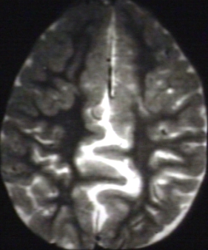 Brain: Arnold Chiari II, with Fenestrated Falx Cerebri and Interdigitating Gyri; T2 (MRI)