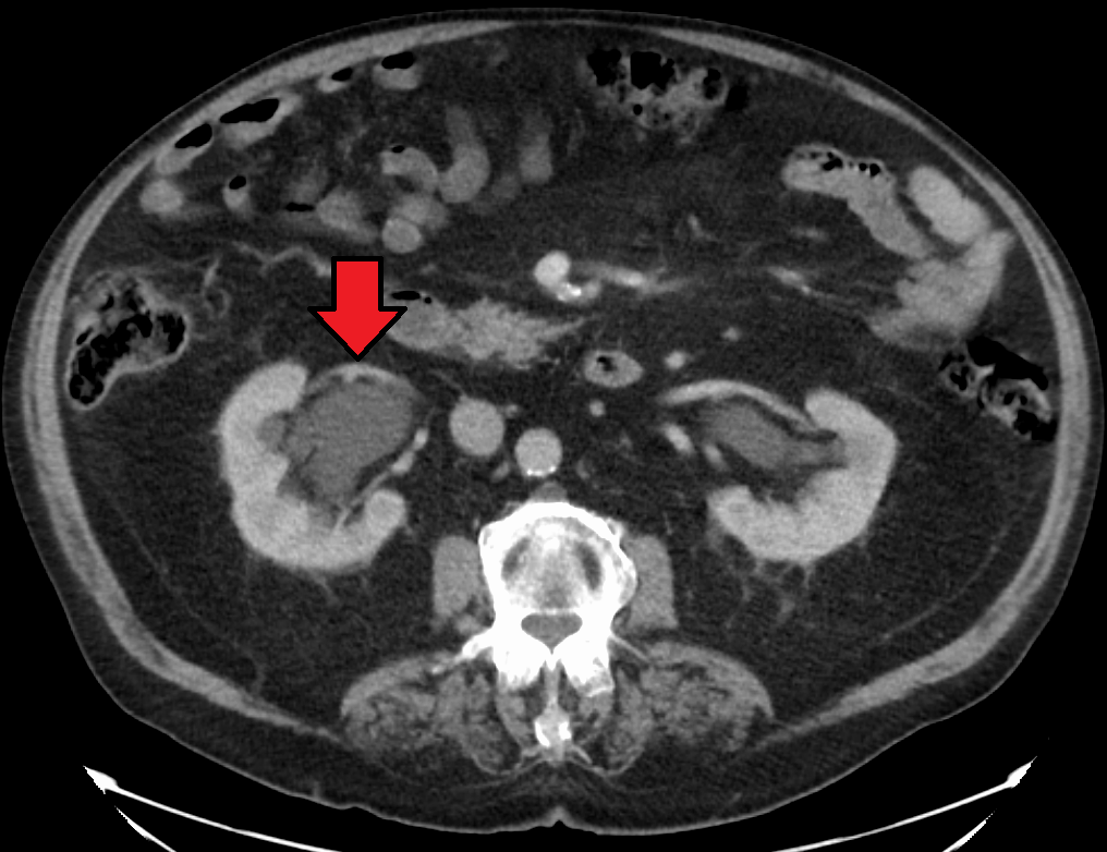 File:Bilateral-Hydronephrosis.png