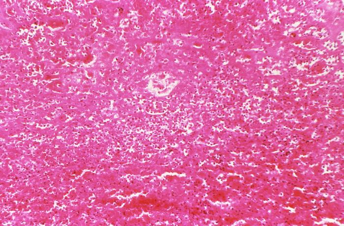 "Hematoxylin-eosin (H&E)-stained photomicrograph of a mediastinal lymph node tissue sample revealed the presence of histopathologic changes indicative of medullary hemorrhage and necrosis in a case of fatal human anthrax.Adapted from Public Health Image Library (PHIL), Centers for Disease Control and Prevention.[20]