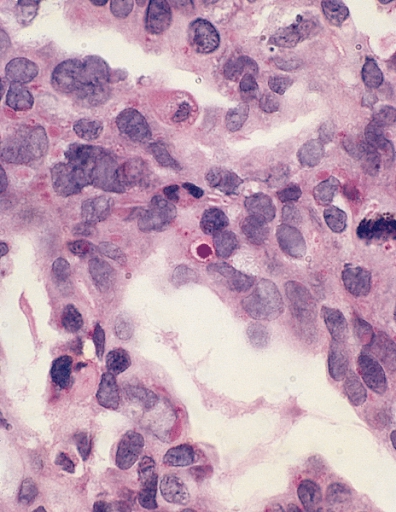 METASTATIC ADENOCARCINOMA: PERICARDIUM Intracytoplasmic globules containing PAS-positive material are seen in adenocarcinoma and are absent in mesothelioma and reactive mesothelial cells. (Periodic acid-Schiff after diastase pretreatment).