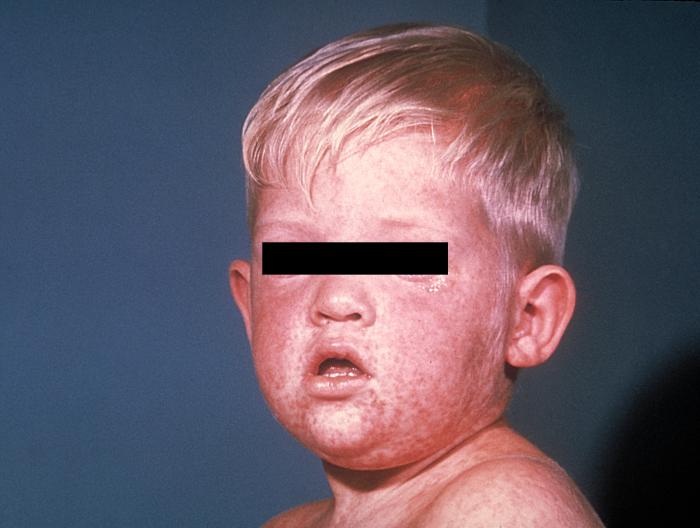 Typical appearance of rash on day 3, measles.