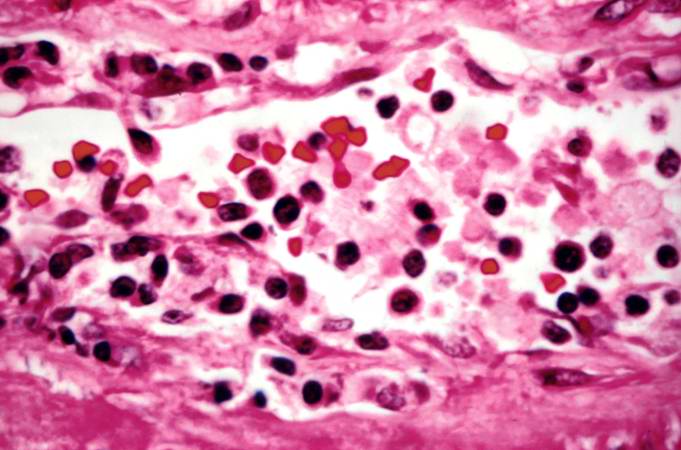 This is a high-power photomicrograph of cells infiltrating the wall of the blood vessel.