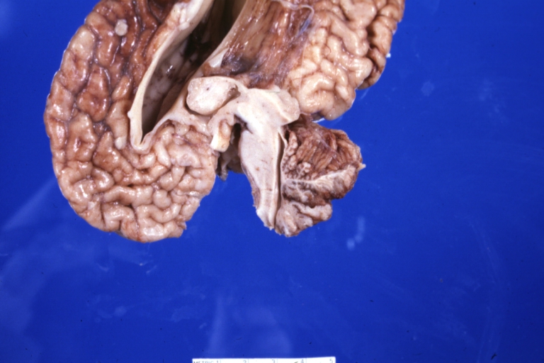Brain: Arnold Chiari Malformation: Gross fixed tissue sagittal section cerebrum brainstem and cerebellum