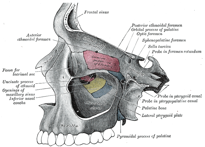 Left maxillary sinus opened from the exterior.