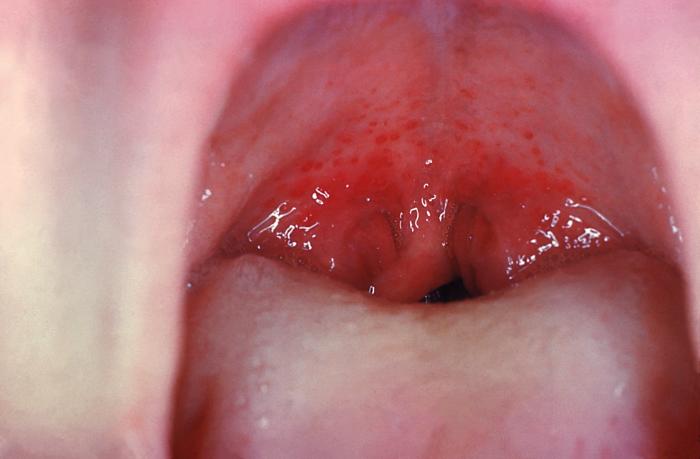 Note the redness and edema of the oropharynx, and petechiae, or small red spots, on the soft palate caused by Strep throat.
