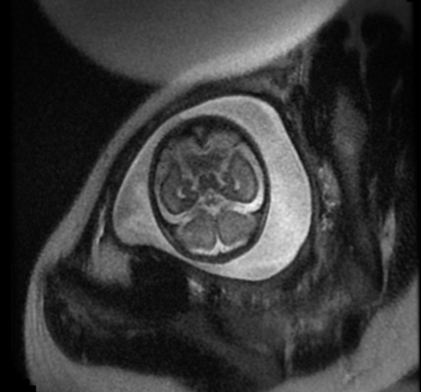 Fetal MRI: Aqueductal stenosis