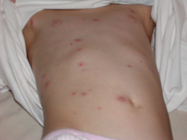 Image of Breakthrough Chickenpox: Back of child with breakthrough varicella.