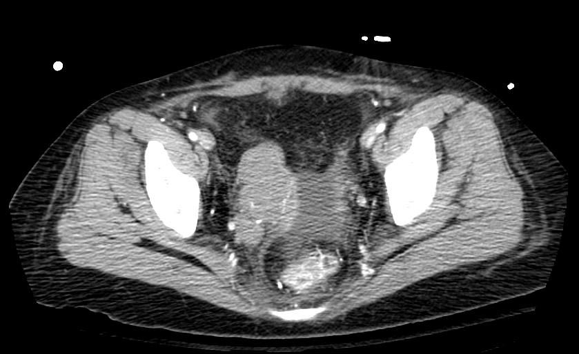 CT in Intravenous leiomyomatosis
