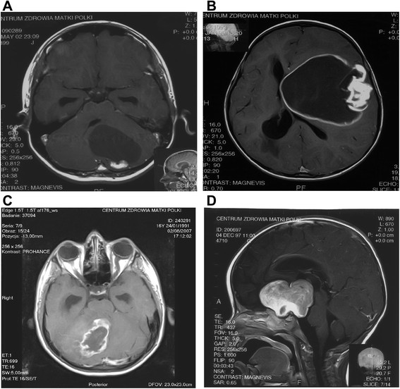 Radiological type of pilocytic astrocytoma (MRI scans after contrast administration). a cystic tumor with an enhancing cyst wall, R1, b cystic tumor with a non-enhancing cyst wall, R2, c solid tumor with central necrosis, R3, and d solid or mainly solid tumor, R4. MRI scans after contrast administration.[1]