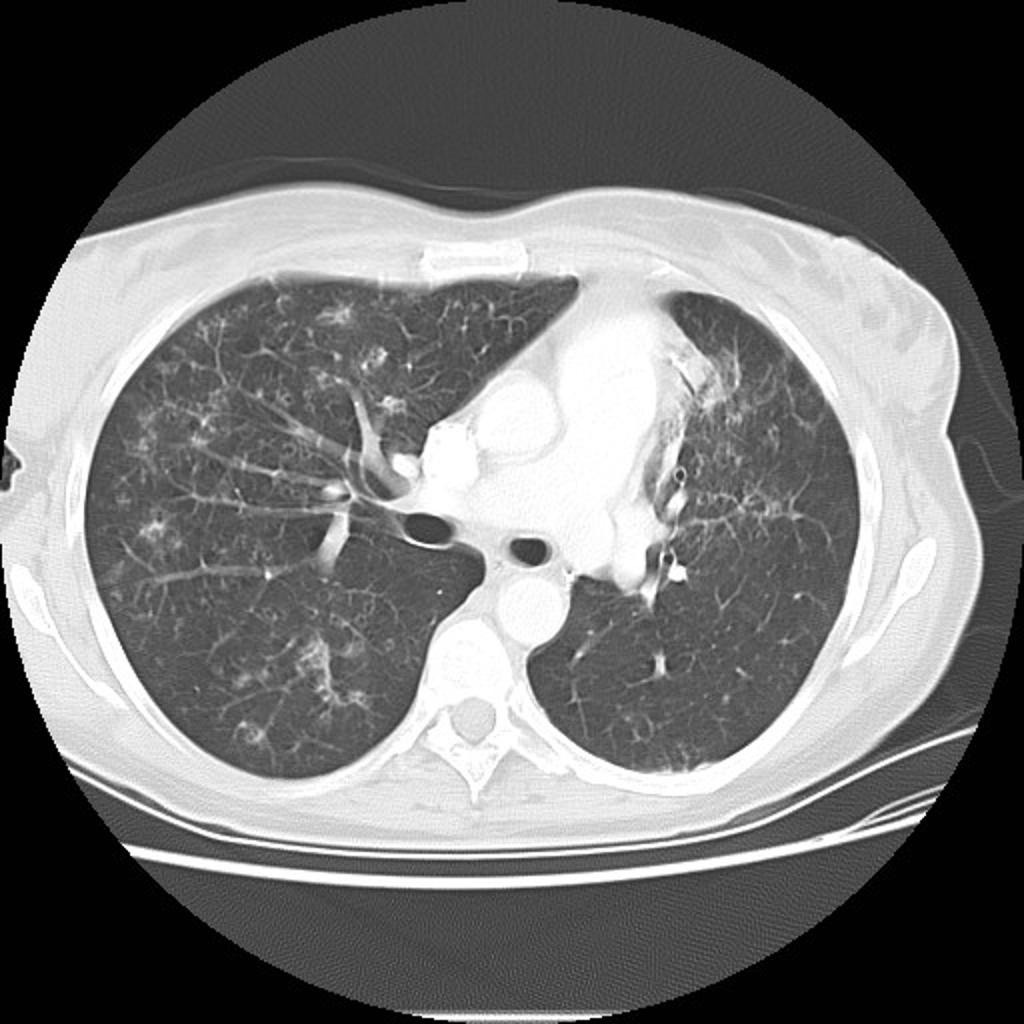 File:Multifocal-adenocarcinoma-of-lung-08.jpg