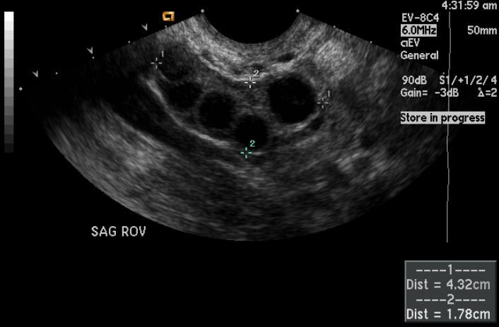 File:Ovarian-hyperstimulation-003.jpg