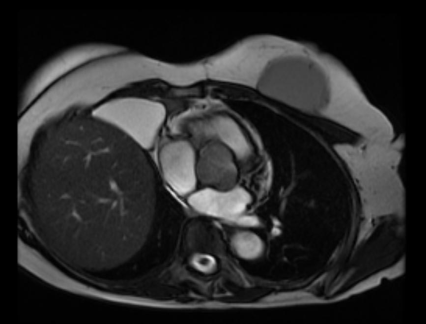 CT showing Pericardial cyst Image courtesy of RadsWiki and copylefted