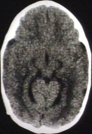 Brain: Arnold Chiari II, 6 months Post-Shunt (CT)