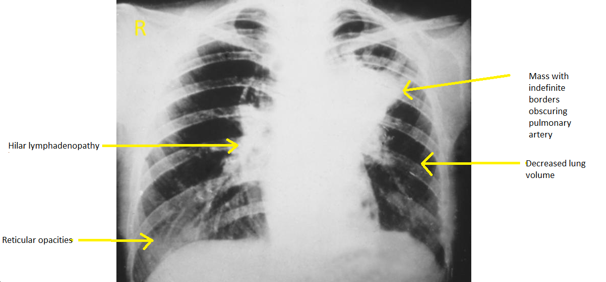 File:Blastomycosis Chest Xray.png