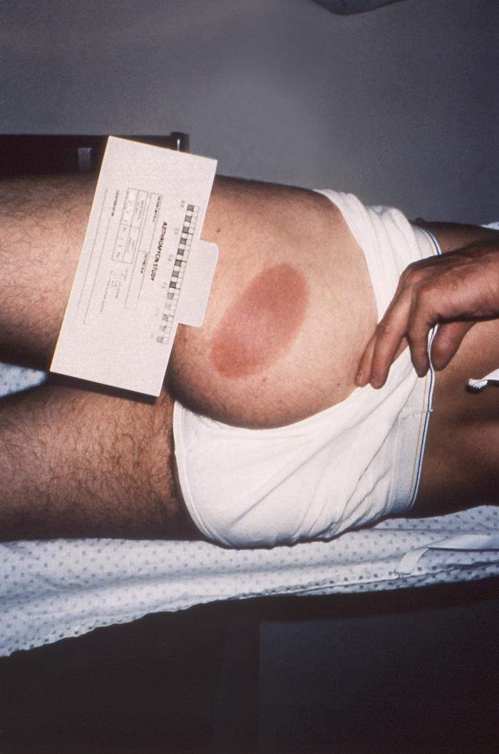 This image depicts the left lateral buttock, or gluteal region of a patient who’d presented with the erythema migrans (EM) rash characteristic of what was diagnosed as Lyme disease, caused by the bacterium, Borrelia burgdorferi. From Public Health Image Library (PHIL). [1]