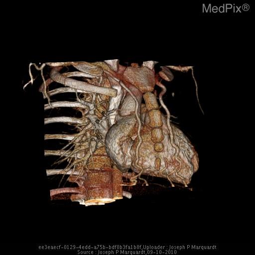 File:CT angiography Coarctation of Aorta Enlarged Internal Mammary Arteries.jpg