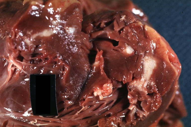 HEART: Metastatic Carcinoma: Gross, primary location is trachea. A good example with lesions in myocardium