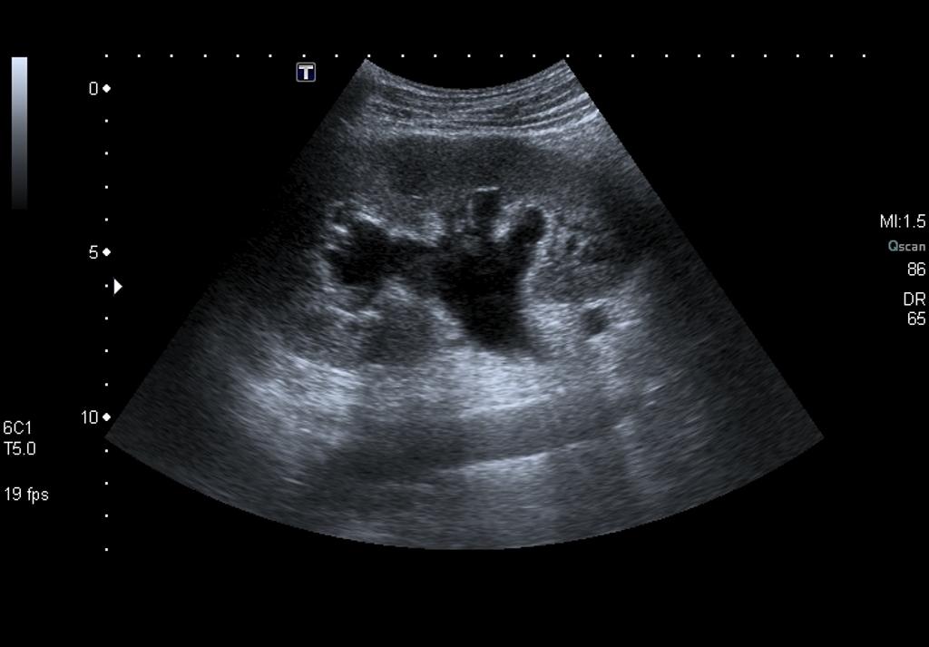 File:Kidney Stones On Ultrasound.jpg