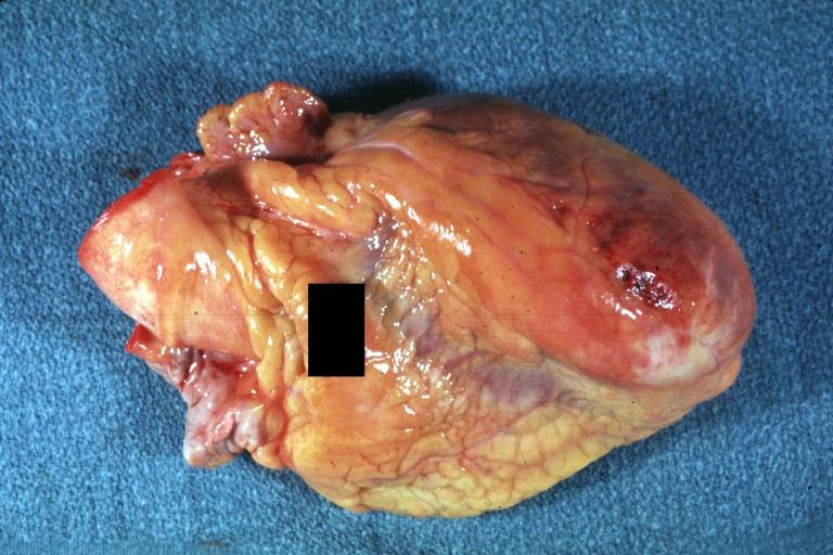 Gross, Acute MI, external view of ruptured myocardial infarction near apex