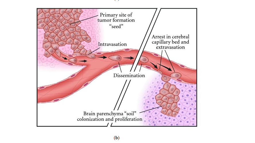 (b) The metastatic tumor cells detach from the primary site and penetrate the adjacent parenchyma to reach the blood vessels. On reaching the vessels, the cells invade and enter the circulation (intravasation) and then disseminate within the vascular system (left half of figure). These cells eventually adhere to secondary sites “soil” to then extravasate out of the blood vessels and for colonies of metastatic cells (right half of figure).[1]