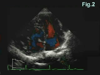 Regurgitation through the left-sided atrioventricular valve is mild. (Courtesy of the National Cardiovascular Center - Japan}