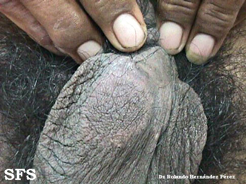 Tuberculoid leprosy. Adapted from Dermatology Atlas.[5]