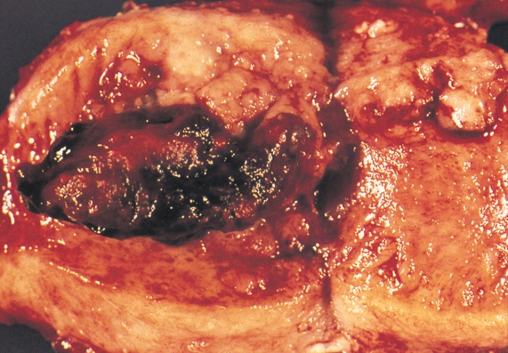 Endometrial adenocarcinoma gross.jpg