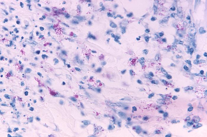 Light photomicrograph revealing some of the histopathologic cytoarchitectural characteristics seen in a mycobacterial skin infection Adapted from Public Health Image Library (PHIL), Centers for Disease Control and Prevention.[20]