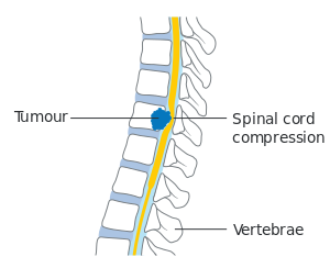 File:Spincal cord compression 1.png