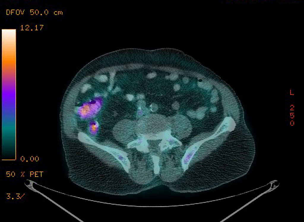 File:Appendiceal-adenocarcinoma-complicated-by-retroperitoneal-abscess (4).jpg