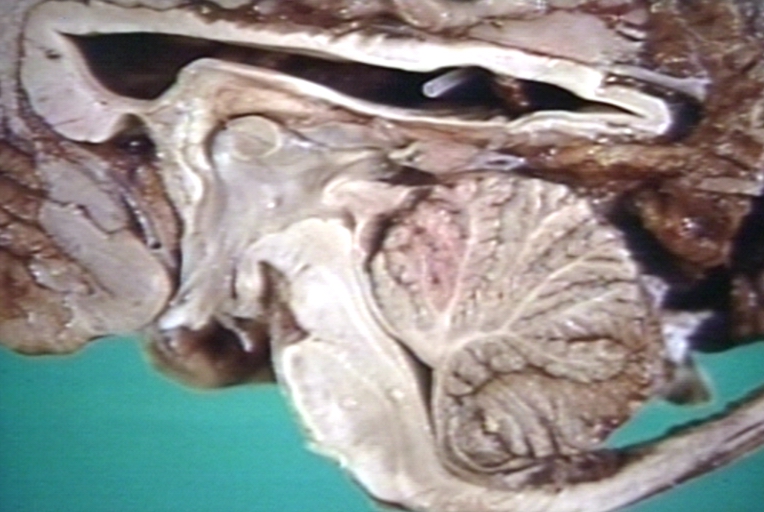 Brain: Arnold Chiari Malformation, a close up view
