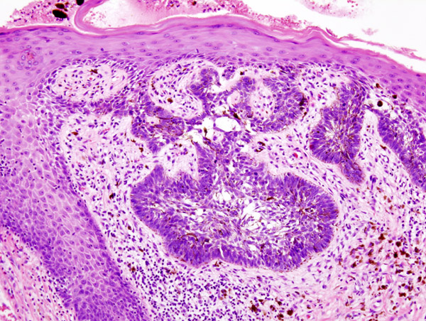 File:Basal cell carcinoma histopathology (3).jpg
