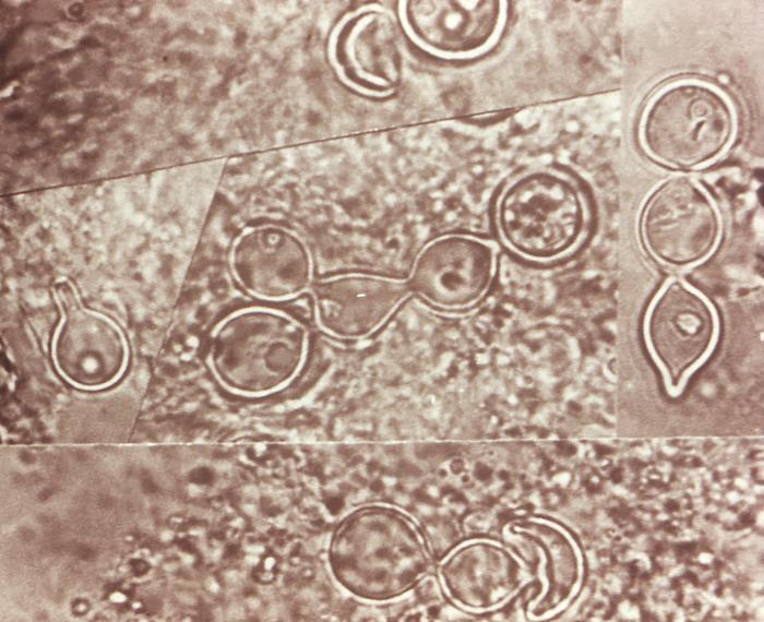 Ultrastructural histopathology in tissue specimen from a patient with a keloidean blastomycosis infection, which was caused by the fungus, Blastomyces dermatitidis. From Public Health Image Library (PHIL). [26]