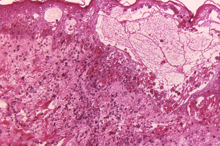 Hematoxylin-eosin (H&E)-stained photomicrograph reveals some of the cytoarchitectural histopathologic changes which you’d find in a human skin tissue specimen that included a chickenpox, or varicella zoster virus lesion (125x mag). From Public Health Image Library (PHIL). [2]