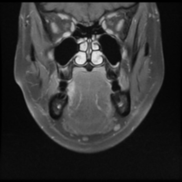 Coronal T1 C1 fat saturated MRI of squamous cell carcinoma of tongue[5]