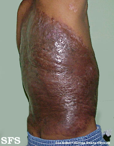 Naevus giant pigmented. Adapted from Dermatology Atlas.[1]
