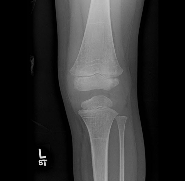 Lucent lesion in the lateral aspect of the left distal femoral epiphysis and joint effusion.